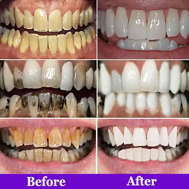 Purple Teeth Whitening Strips
